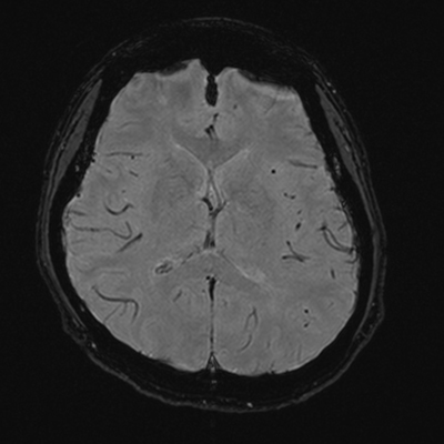 頭のMRI