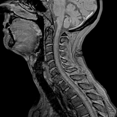 首のMRI