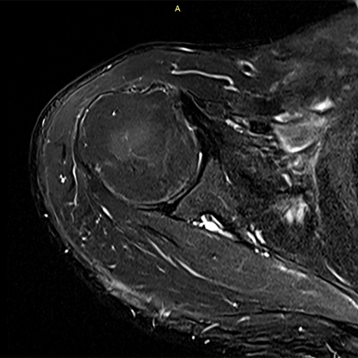 肩のMRI