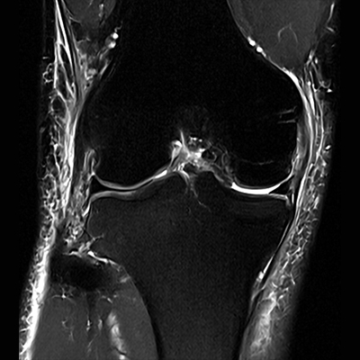 膝のMRI