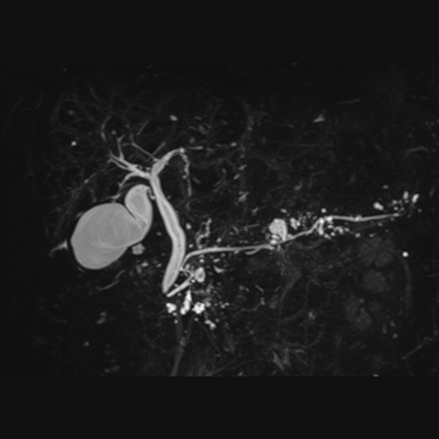 胆のう・胆管・すい臓の管のMRI
