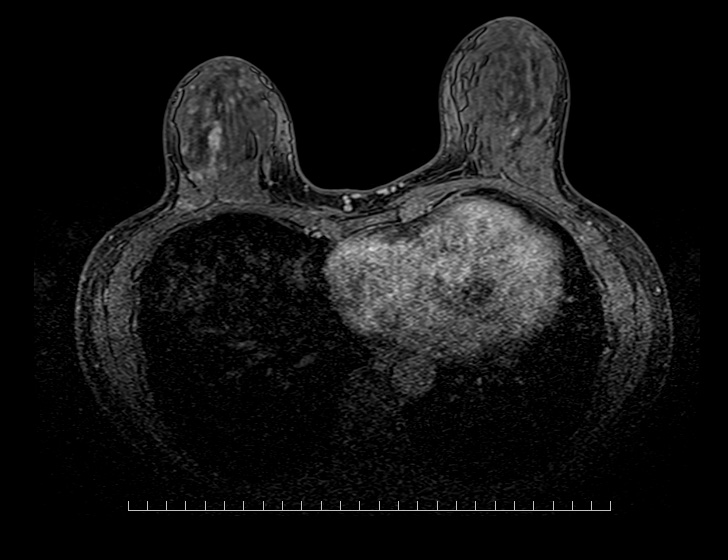 乳腺・造影（横断像）