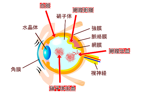 糖尿病網膜症