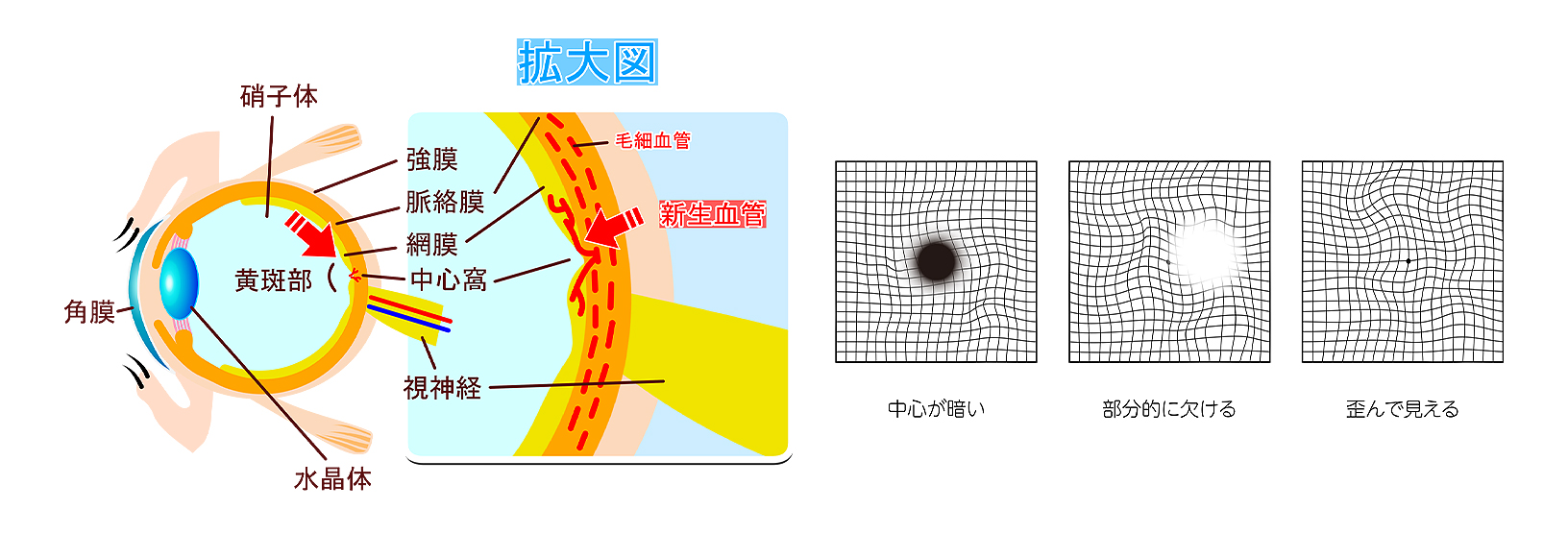 加齢黄斑変性