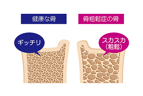 骨粗鬆症のイメージ