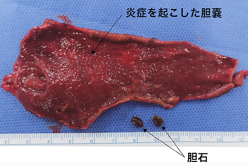 胆嚢をとる手術イメージ